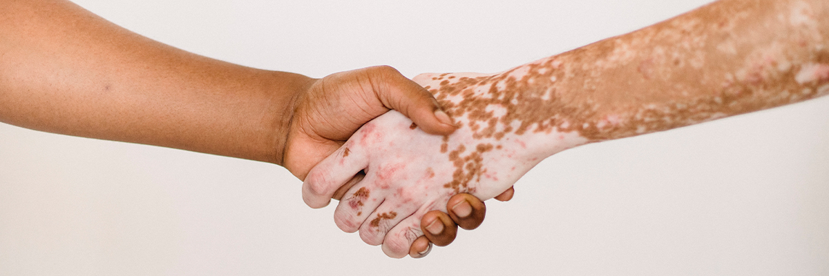Aperto de mãos entre duas pessoas, uma delas com vitiligo